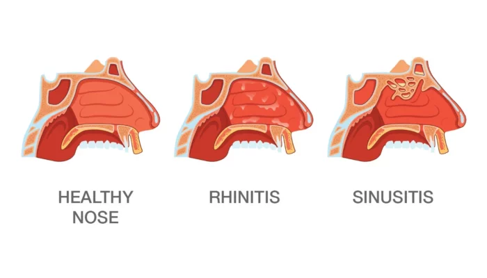 Resep Rhinitis Alergi, Solusi Alami dan Ampuh untuk Atasi Gejala, Bebas Bersin dan Hidung Tersumbat Tanpa Obat